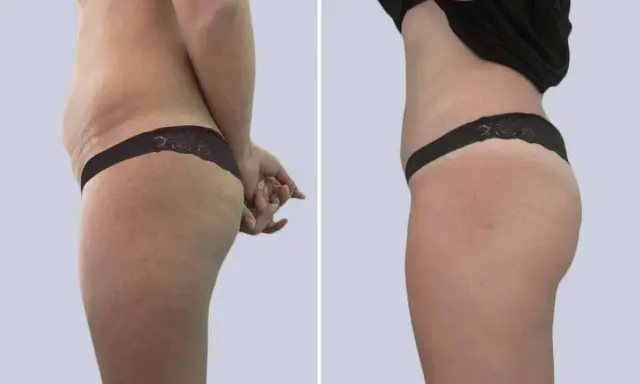 Confronto prima e dopo: la liposuzione come funziona per rimodellare il corpo, riducendo accumuli adiposi e migliorando la silhouette.