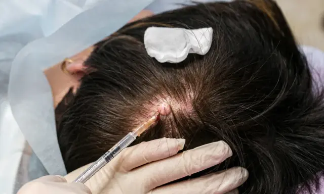 Zabieg usuwania kaszaka na skórze głowy. Strzykawka z lekiem, prawdopodobnie maść na kaszaki, jest wprowadzana do zmiany.
