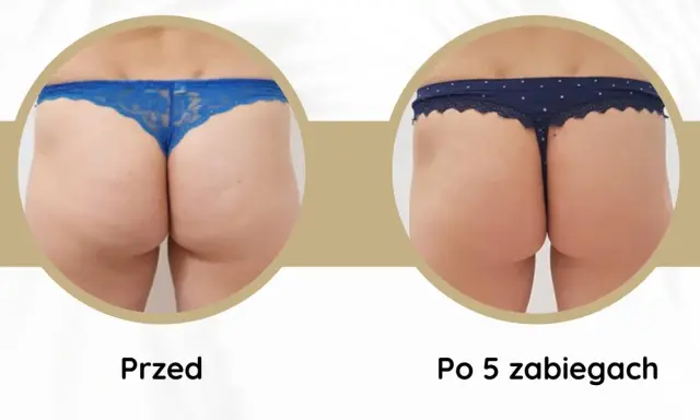 Endermologia: Jak się przygotować? Twój poradnik krok po kroku