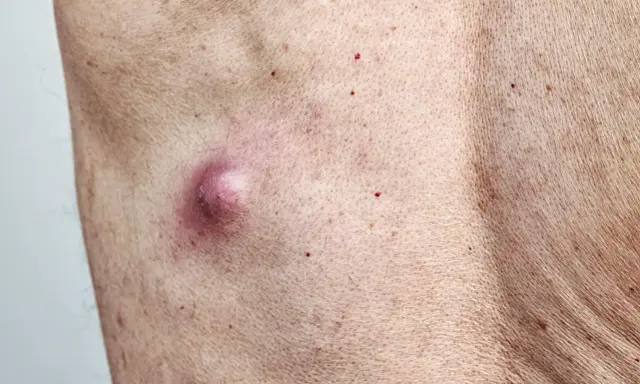 Widoczne grudki perliste u kobiet, jedna z nich jest zaczerwieniona i lekko opuchnięta, otoczona drobnymi czerwonymi kropkami na skórze.