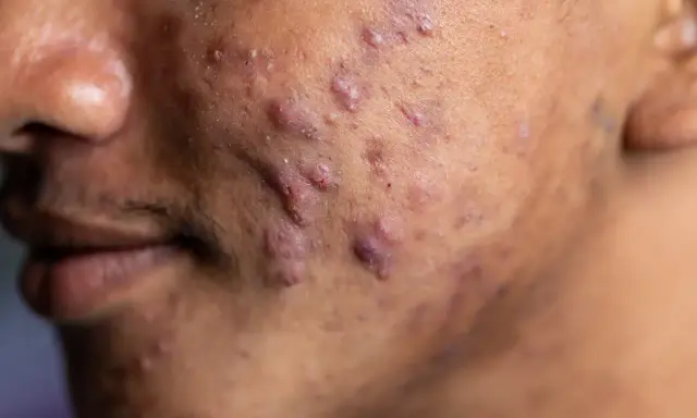 Gros plan sur une peau marquée par de nombreux boutons d'acné, dont un acné nodule particulièrement visible.