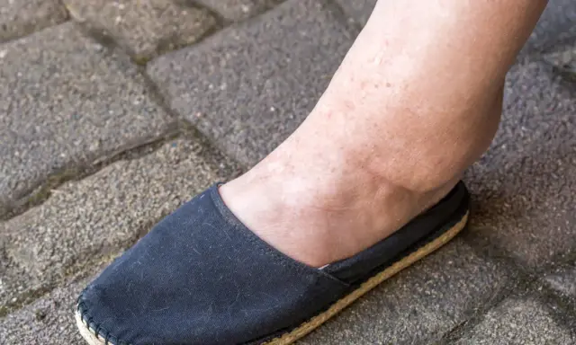 Spuchnięta kostka i stopa w czarnym bucie, objaw problemów z nerkami.