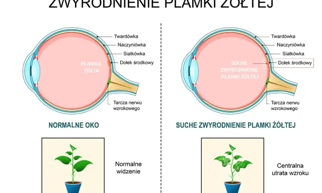 Porównanie normalnego oka z suchym zwyrodnieniem plamki żółtej. Obraz ukazuje zmiany w siatkówce, które mogą prowadzić do obrzęku plamki żółtej i utraty wzroku.