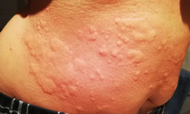Piel con erupciones rojas y elevadas, posibles síntomas de ácaros en la cama.
