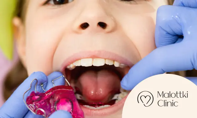 Uśmiechnięte dziecko z różową płytką Hawleya w ustach, przygotowywaną przez dentystę w rękawiczkach.
