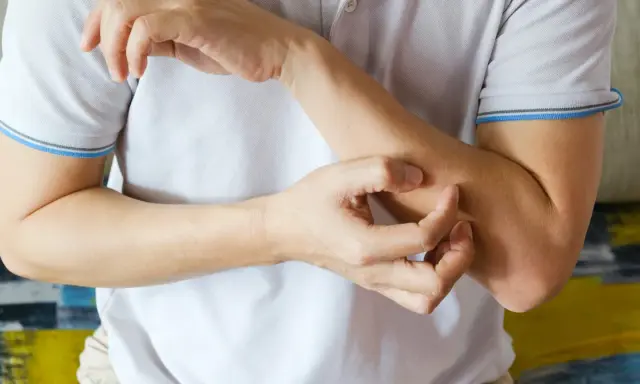 Dłoń drapiąca przedramię, mogące być jednym z objawów skórnych HIV.