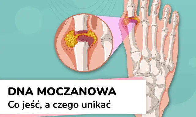 Dna moczanowa: powiększony staw palucha z kryształkami moczanowymi. Wysoki kwas moczowy może prowadzić do bólu.