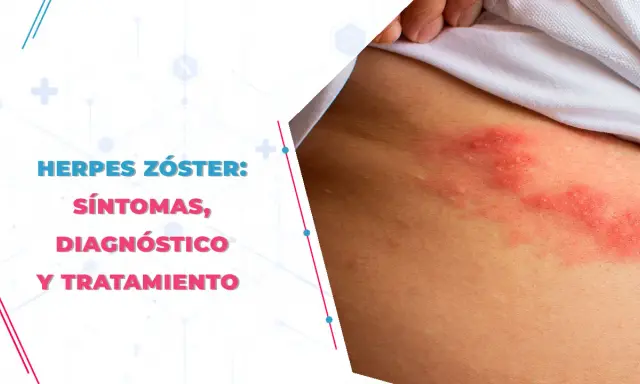 Herpes zóster: Medicamentos esenciales para evitar el dolor crónico