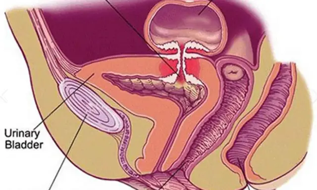 Anatomical diagram showing a colovesical fistula, a connection between the colon and bladder.