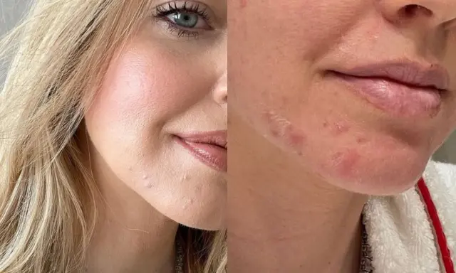 Viso con sfogo cutaneo, forse un'allergia. La pelle presenta rossori e piccole pustole, soprattutto intorno alla bocca e sul mento.