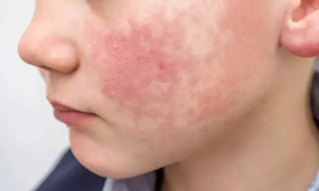Rostro de niño con erupción roja y escamosa, síntoma del virus del tortazo.