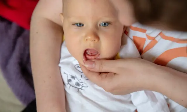 Widok na buzię niemowlaka, któremu rodzic delikatnie podnosi wargę, ukazując, jak wygląda przebijający się zabek.