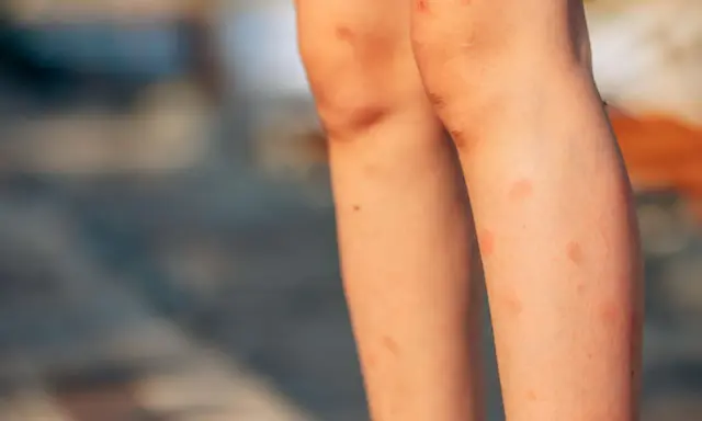 Jambes d'enfant couvertes de rougeurs, un bouton de moustique qui ne part pas, avec quelques éraflures sur les genoux.