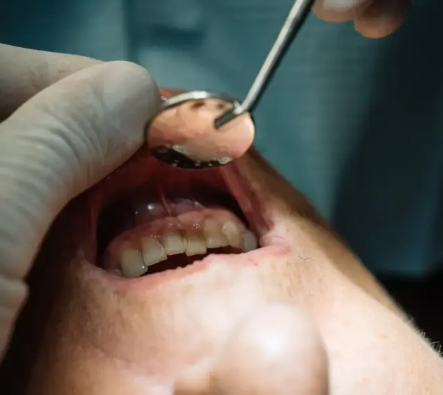 Dentysta bada jamę ustną, widoczny jest ropień przyzębia.