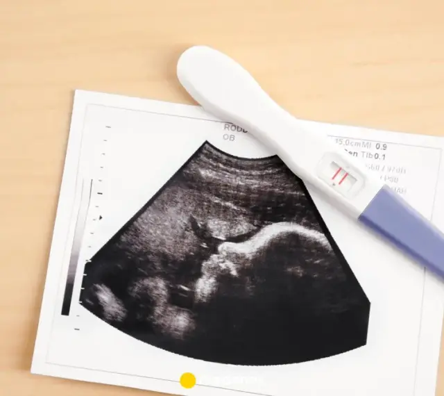 USG pokazuje pęcherzyk ciążowy, a obok leży pozytywny test ciążowy.