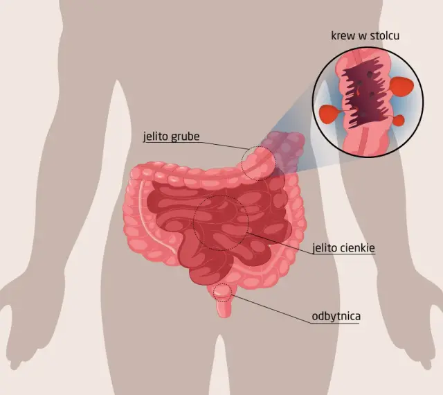Ilustracja układu pokarmowego z zaznaczonym jelitem grubym, cienkim i odbytnicą. Powiększony fragment pokazuje krew w stolcu, co oznacza dodatni wynik badania na krew utajoną.