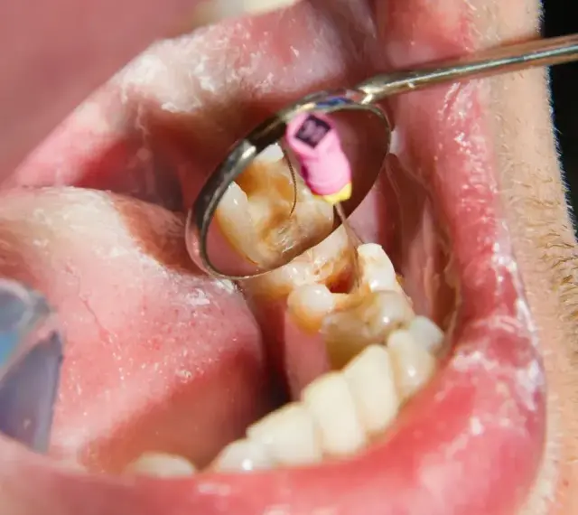 Zabieg stomatologiczny: w lusterku widać narzędzie dentystyczne z różowym elementem, które jest używane do leczenia zęba z podejrzeniem ropień zęba.