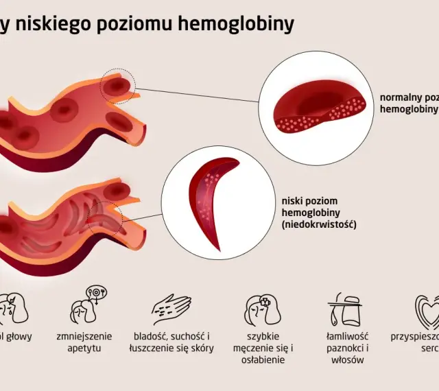 Ilustracja porównująca krwinki czerwone przy normalnym i niskim poziomie hemoglobiny, z ikonami objawów.