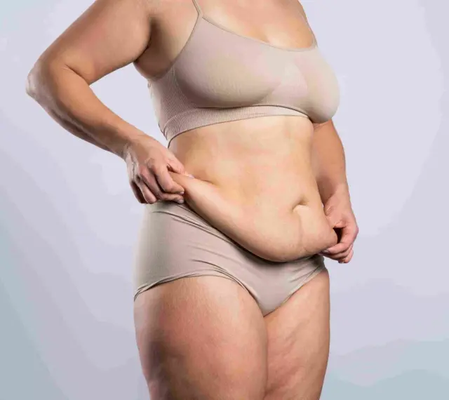 Kobieta w bieliźnie pokazuje fałdy brzuszne, rozważając abdominoplastykę.