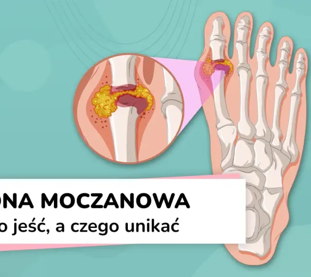 Dna moczanowa: powiększony staw palucha z kryształkami kwasu moczowego. Objawy dny moczanowej mogą być bolesne.