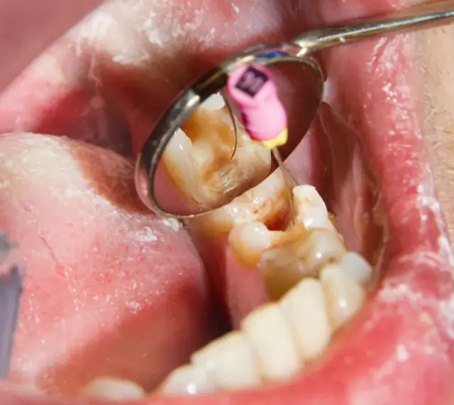 Dentysta podczas leczenia kanałowego zęba. W odbiciu lusterka widać narzędzie stomatologiczne i różowy kołeczek z oznaczeniem rozmiaru.