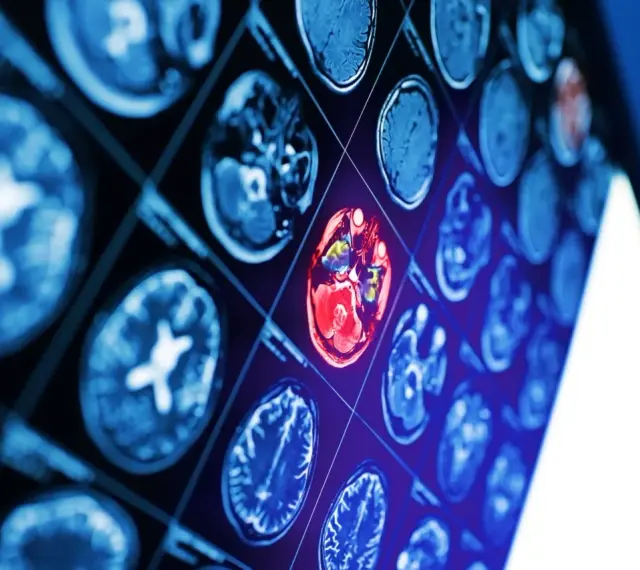 Sekwencja obrazów neurotop z wyróżnionym czerwonym obszarem mózgu, sugerującym nieprawidłowość.