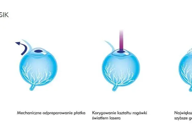 Korekcja krótkowzroczności: Od okularów po laser wybierz mądrze!