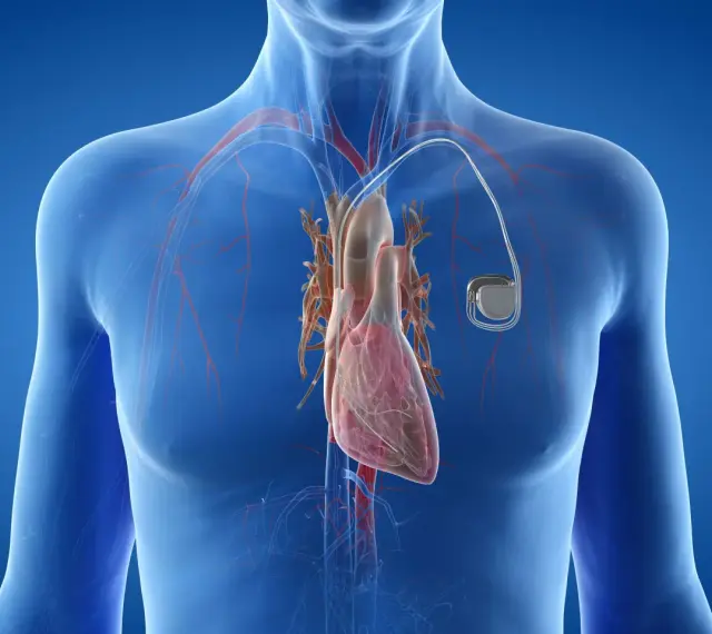 Anatomical illustration of a human heart with a pacemaker. Zastanawiasz się, ile się czeka na wszczepienie rozrusznika serca?