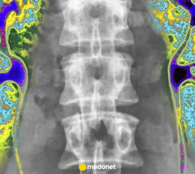 Kolorowa scyntygrafia kości pokazuje nerki i kręgosłup. Obraz uwidacznia obszary o różnej aktywności metabolicznej.