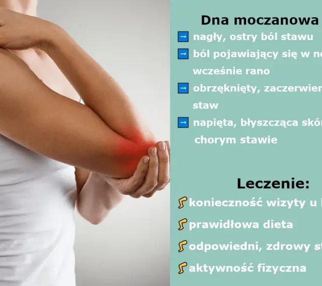 Dna moczanowa objawia się nagłym bólem stawu, obrzękiem i zaczerwienieniem. Leczenie obejmuje wizytę u lekarza, dietę i aktywność fizyczną.
