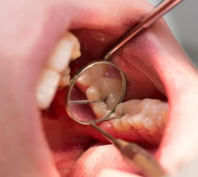 Dentysta bada zęby, widoczne są oznaki chorób zębów, takie jak ubytek.