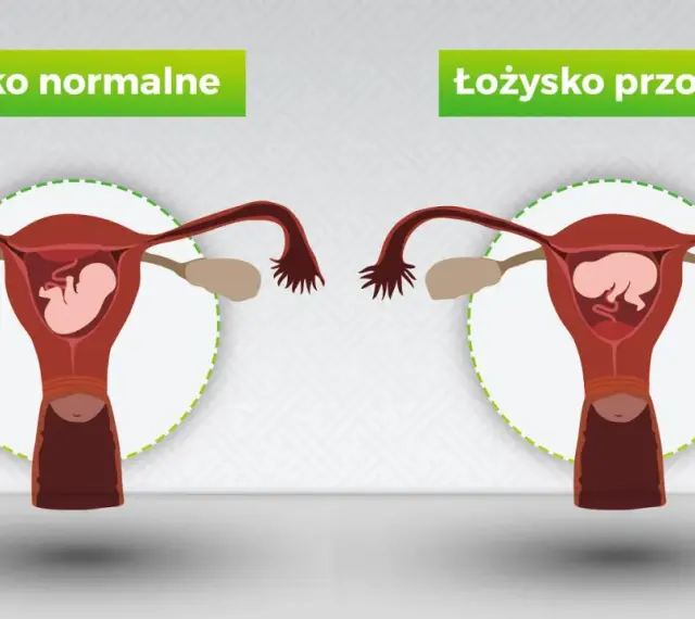Porównanie: łożysko normalne vs łożysko przodujące. Po prawej stronie widoczna macica z płodem i łożyskiem przodującym, blokującym szyjkę macicy.