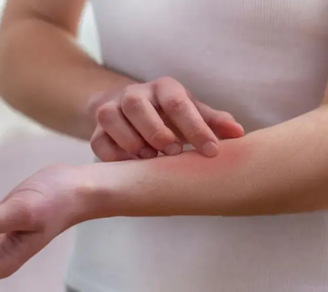 Dłoń drapiąca zaczerwienioną skórę na przedramieniu, objaw mogący wskazywać na lupus.