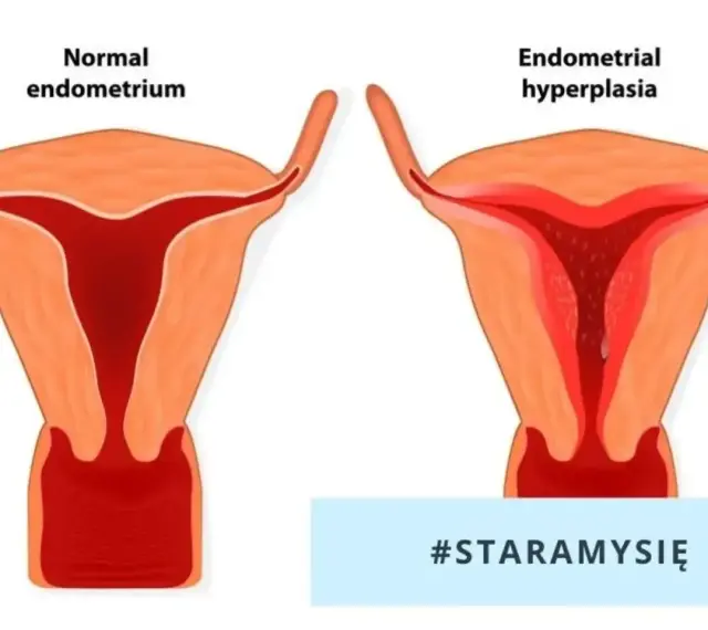 Porównanie prawidłowego endometrium z jego przerostem. Po lewej zdrowa macica, po prawej przerost endometrium.