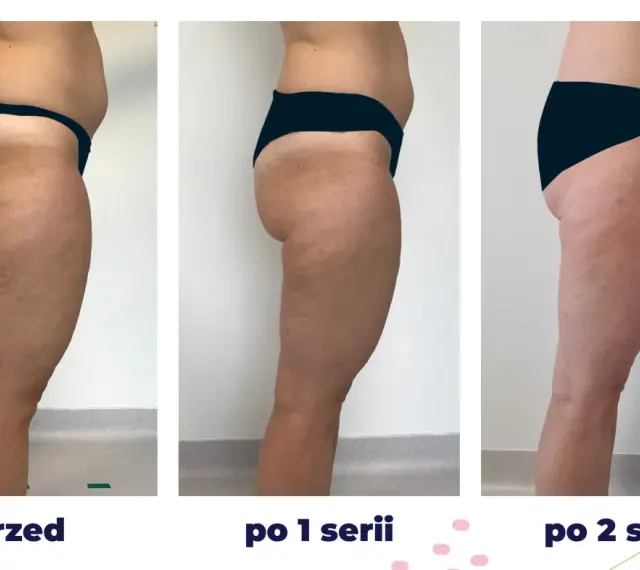 Efekty zabiegu iCoone na uda: przed, po 1 i po 2 seriach. Widoczna redukcja cellulitu i poprawa jędrności skóry.