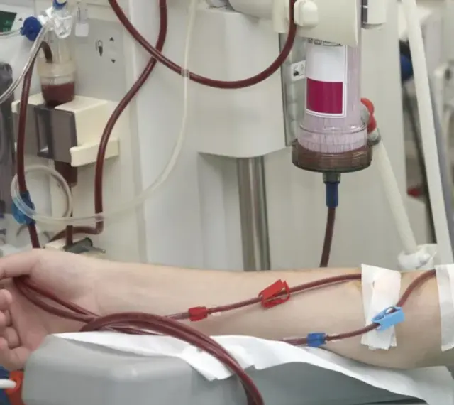 Ramię pacjenta podłączone do aparatury dializacyjnej z widocznymi przewodami i filtrem.