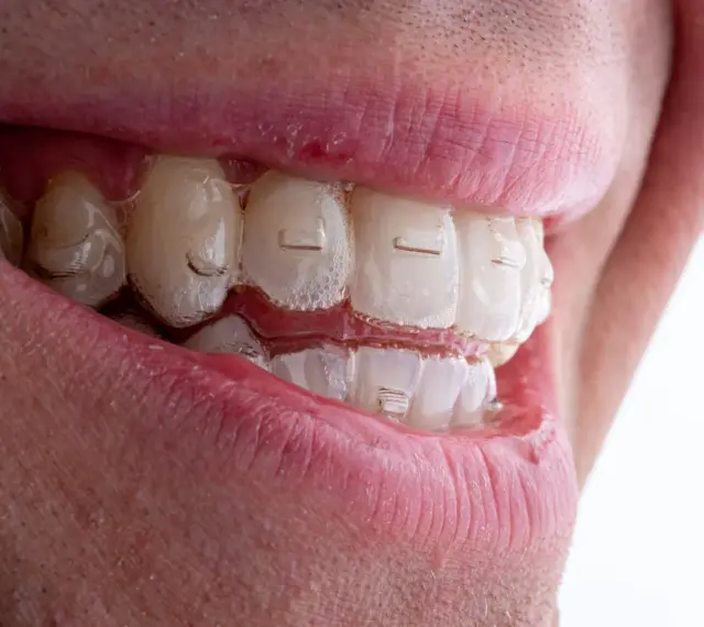 Uśmiech z przezroczystymi nakładkami Invisalign. Zastanawiasz się nad Invisalign cena? To inwestycja w prosty zgryz.