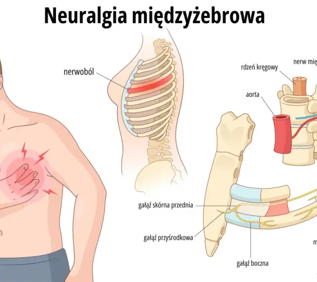 Ilustracja przedstawia mężczyznę z bólem w klatce piersiowej, wskazującym na neuralgia potyliczna objawy. Pokazuje unerwienie żeber i kręgosłupa.