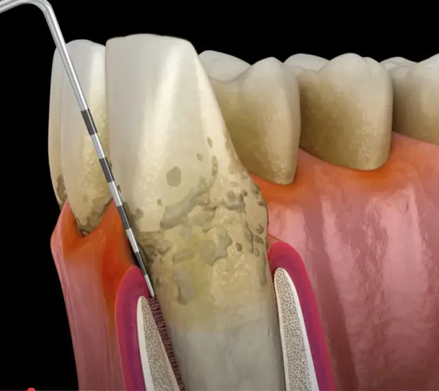 Model stomatologiczny pokazujący postępujące choroby dziąseł, z widocznym kamieniem nazębnym i narzędziem dentystycznym.