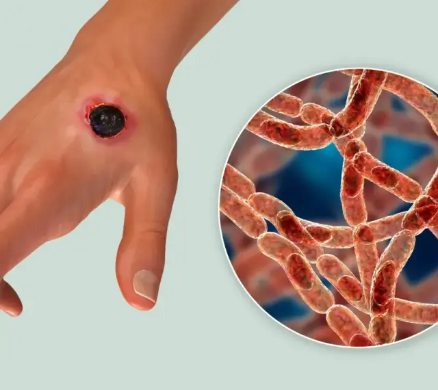 Dłoń z czarną martwiczą zmianą skórną, objawem wąglika. Obok powiększenie bakterii Bacillus anthracis.