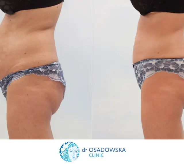 Przed i po zabiegu liposukcji laserowej. Widoczna redukcja tkanki tłuszczowej na brzuchu i biodrach. Opinie pacjentek potwierdzają skuteczność.