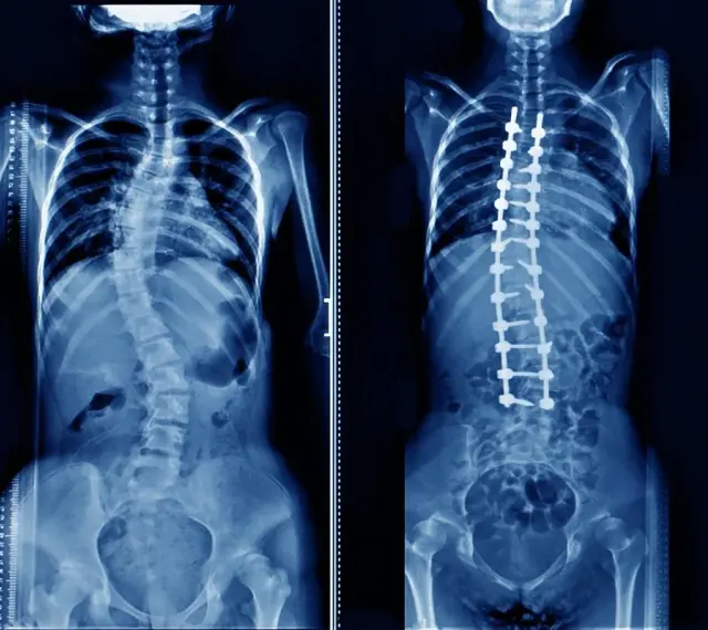 Rentgen klatki piersiowej przed i po operacji skoliozy. Widoczny kręgosłup z implantami stabilizującymi.