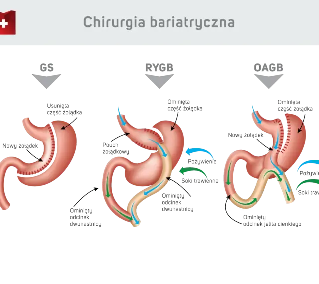 Ilustracja porównuje trzy typy operacji bariatrycznych: GS, RYGB, OAGB. Dowiedz się, ile kosztuje operacja bariatryczna i jakie są jej rodzaje.