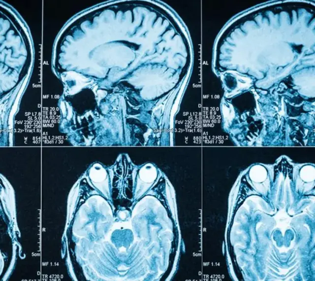 Przekroje mózgu na rezonansie magnetycznym, pokazujące jego strukturę. Obraz może pomóc w diagnostyce objawów guza mózgu.