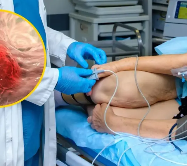 Lekarz w rękawiczkach przygotowuje pacjenta do zabiegu, ilustrując najnowsze metody leczenia raka jelita grubego. W powiększeniu widać komórki nowotworowe.