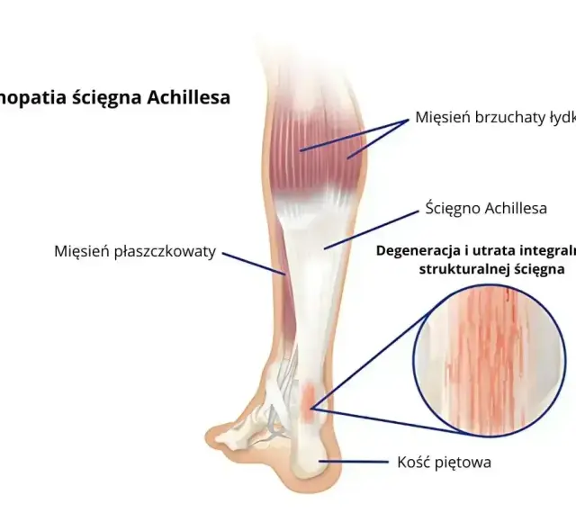 Anatomia podudzia człowieka z zaznaczonym ścięgnem Achillesa, mięśniami i kością piętową. Widoczna degeneracja ścięgna.