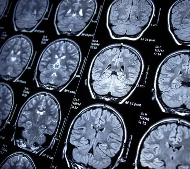 Przekroje mózgu na rezonansie magnetycznym, ukazujące jego strukturę. Badanie może pomóc w diagnozowaniu schorzeń, takich jak epilepsja.