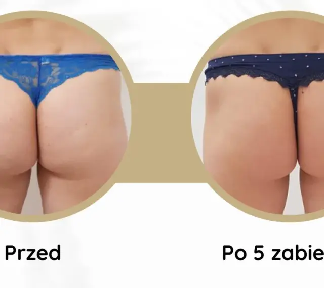 Widoczne **efekty endermologii po 6 zabiegach** na pośladkach. Skóra jest gładsza, bardziej jędrna i napięta.