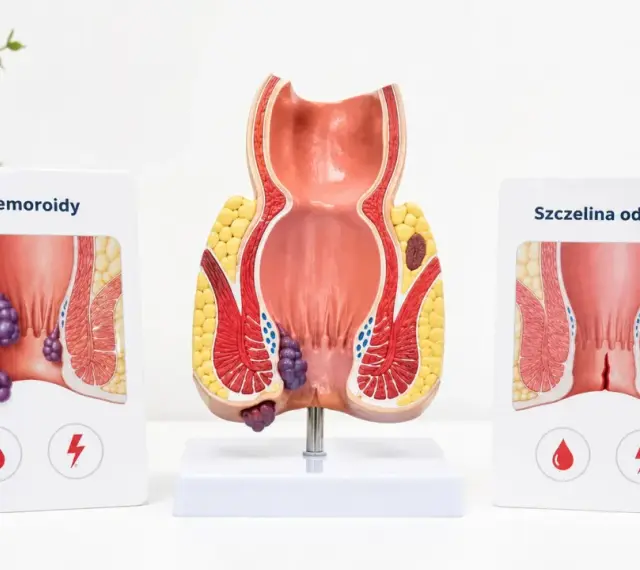 Model anatomiczny odbytu z widoczną szczeliną odbytu i hemoroidami. Obrazek po prawej pokazuje szczelinę odbytu, a po lewej hemoroidy.