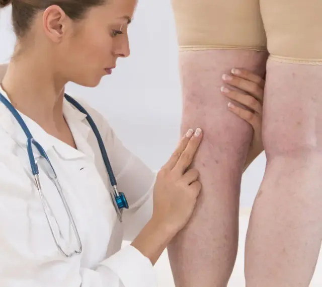 Lekarka bada nogi pacjentki z widocznymi żylakami. D-dimery mogą być badane w diagnostyce zakrzepicy.